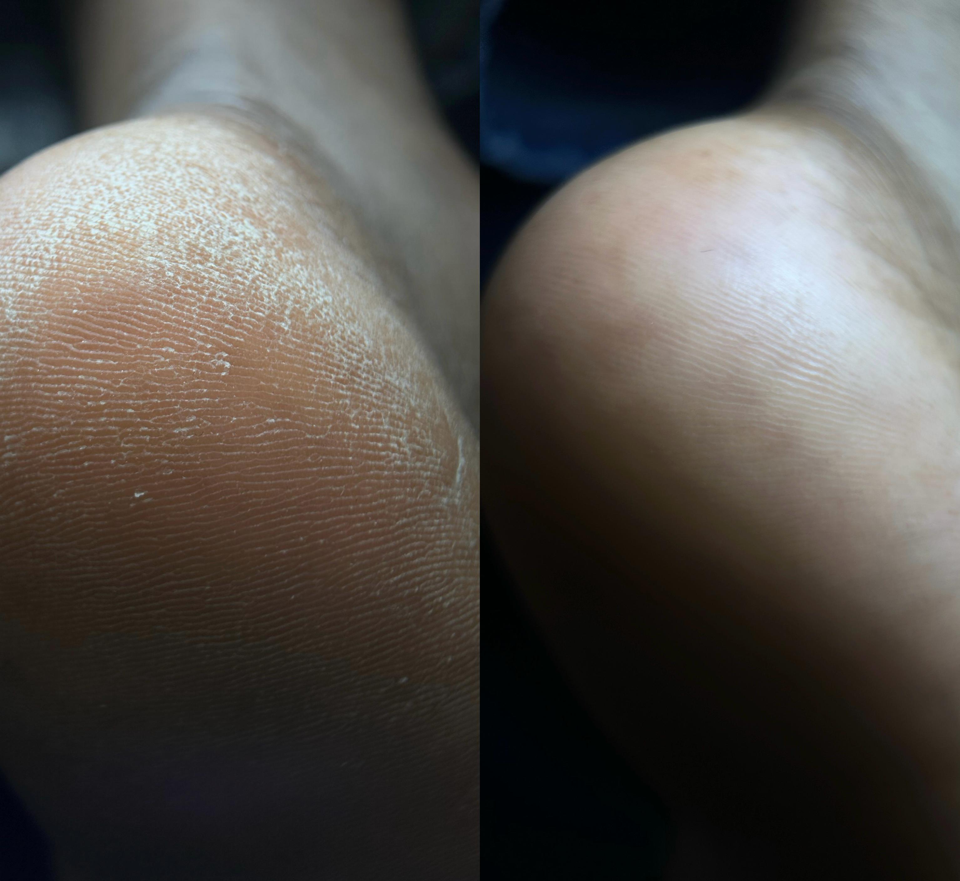 SOINS ANTI CALLOSITÉS